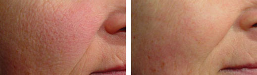 Image result for cutera laser genesis rejuvenation before and after 